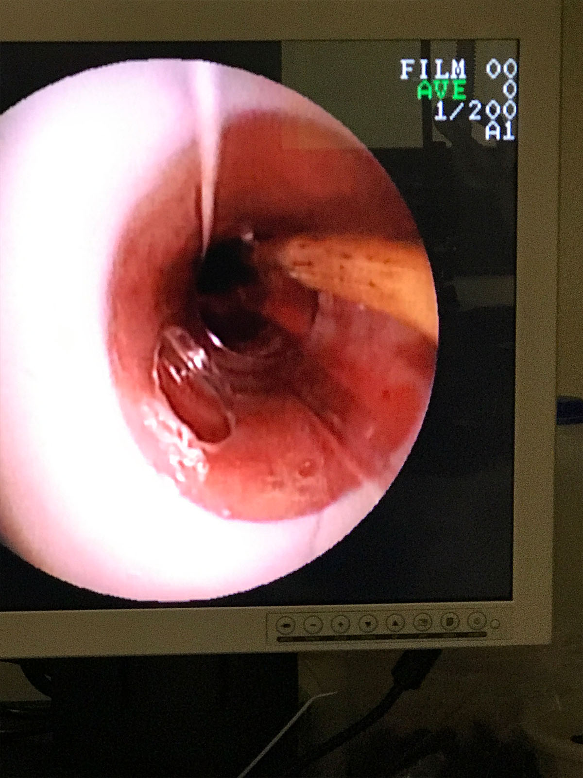 a close-up view from a medical endoscope showing a narrow
