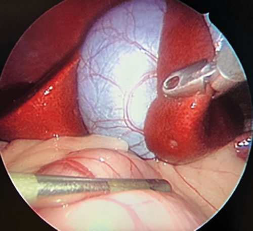 pet-diagnostic-liver-laparoscopy pet-diagnostic-liver-laparoscopy