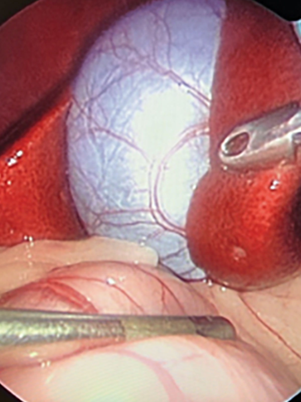 pet-diagnostic-liver-laparoscopy-service